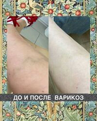 Наталия Травникова Варикоз 2025