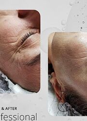 феруловий пілінг ferulac peel, який стирає зморшки