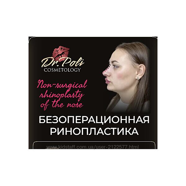 Безоперационная ринопластика 2025 Полина Еремина